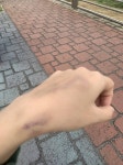 밖에서 보니 손등에 멍이 더 잘보인다ㅋㅋㅋㅋ - 인스티즈(instiz) 일상 카테고리 밖에서 보니 손등에 멍이 더 잘보인다ㅋㅋㅋㅋ