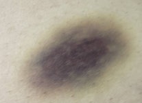 이런 멍 처음 들어봐 - 인스티즈(instiz) 일상 카테고리 이런 멍 처음 들어봐