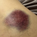 [잡담] ㅎㅇㅈㅇ 멍이 엄청 크게 들었는데 ㅜㅜ - 인스티즈(instiz) 일상 카테고리 ㅎㅇㅈㅇ 멍이 엄청 크게 들었는데 ㅜㅜ