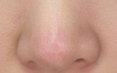 [잡담] 코에 빨간여드름?났는데(혐오주의) - 인스티즈(instiz) 일상 카테고리