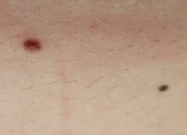 왼쪽 큰점이 간지럽고 울퉁불퉁한데..혹시 피부암은 아니겠지???... - 인스티즈(instiz) 일상 카테고리 왼쪽 큰점이 간지럽고 울퉁불퉁한데..혹시... 