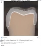 금니로 씌워야 하나.. 지르코니아, 도자기로 씌워야 하나.... - 인스티즈(instiz) 이슈 카테고리 금니로 씌워야 하나.. 지르코니아, 도자기로... 