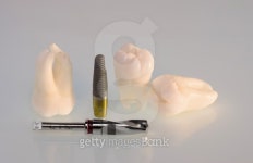 Teeth and Dental Implant 이미지 (127001863) - 게티이미지뱅크 Teeth and Dental Implant