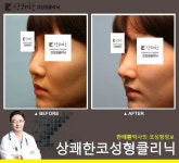 이비인후과코성형으로 비염수술까지 했어요