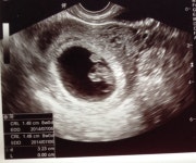 화학적유산후 임신! 희망을 가지시라고..