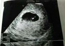 절박유산 진단받았어요