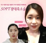 광대뼈축소술 미인만들기에서 알아봤어요