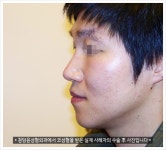 남자코성형은 청담윤성형외과가 괜찮더라구요!