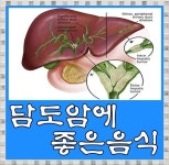 담도암1기 2기 3기 4기 생존율과 담도암에 좋은 음식