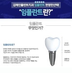 김해치과 임플란트 알아보기