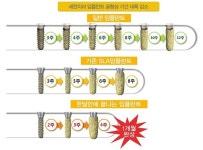 수원임플란트 고민중이라면