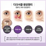눈밑성형과 다크써클효과까지! 눈밑지방재배치후기로 확인해봐~