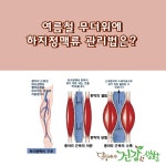 여름철 무더위에 하지정맥류 관리법은?