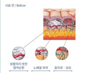 송도동피부과 다이어트!