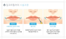 구미인동피부과 자연스러운 스마일라인!