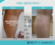 종아리튼살치료 받으니까 괜찮아지네요