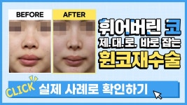 수술 후 휜코, 원인을 알면 바로 잡을 수 있다! | 휜코재수술 핵심 포인트 | AND(앤드)성형외과 - kakaoTV 수술 후 휜코... 