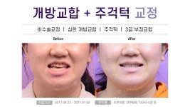 부산해운대교정치과 개방교합 비수술주걱턱교정 Before&After ::뉴욕스마일치과교정과치고의원 - kakaoTV ﻿부산해운대교정치과... 