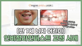 만 7살 초등학생 - 인비절라인퍼스트 투명교정으로 부정교합(반대교합)개선한 사례 (강남치아교정-오리건치과) - kakaoTV 만 7살 초등학생... 