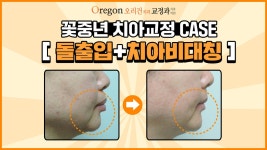 강남대치동교정치과_오리건치과】 - kakaoTV 중년치아교정... 돌출입 + 치아비대칭 교정 CASE【Feat. 강남대치동교정치과_오리건치과】