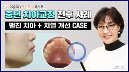 아랫니발치 후 뻗친치아와 치열 개선한 중년교정CASE【Feat. 강남교정치과 김옥경원장님】 - kakaoTV 아랫니발치 후 뻗친치아와 치열... 