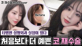 (코 재수술)일본 성형외과 상담실장이 한국에서 코재수술 받았어요! 코재수술 잘하는 병원! - kakaoTV (코 재수술)일본 성형외과 상담실장이... 