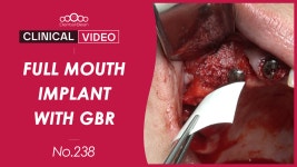 조용석 원장의 Full mouth implant with GBR - kakaoTV 조용석 원장의 Full mouth implant with GBR