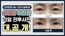 | 모차르트 인기시술✨ | 모차르트성형외과 - kakaoTV 상안검하안검 리얼 전후사진이 궁금하다면 𝐂𝐥𝐢𝐜𝐤‼ | 모차르트 인기시술... 