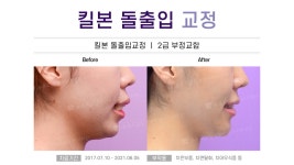 치과교정과 치과의원 - kakaoTV ﻿부산 킬본돌출입교정 전후사진 Before&After :: 부산 해운대 좌동 ﻿뉴욕스마일 치과교정과 치과의원