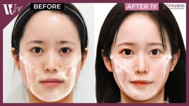안면윤곽한지 1년이 지난 일본인, 지금은 얼마나 달라졌을까? - kakaoTV 안면윤곽한지 1년이 지난 일본인, 지금은 얼마나 달라졌을까?