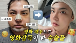 배우들 수소문해 성형외과 알아낸 영화 감독 | 눈매교정+코재수술+윤곽3종 4개월 차 후기 - kakaoTV ...