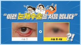 이런 눈재수술 처음 봅니다!!😲🔥 ㅣ수원 이상호성형외과 - kakaoTV 이런 눈재수술 처음 봅니다!!😲🔥 ㅣ수원 이상호성형외과