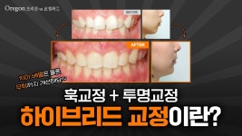 예쁜 턱 라인은 덤입니다😍 【오리건치과교정과】 - kakaoTV 하이브리드 교정으로 디테일하게 교정해드렸어요! 예쁜 턱 라인은 덤입니다... 