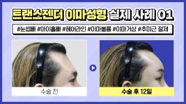 #트랜스젠더 이마거상술 실제 환자 첫 번째 사례! 지금 바로 영상을 통해 확인해 보세요 - kakaoTV #트랜스젠더 이마거상술... 