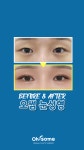 반짝반짝 달라진 눈빛✨ 오썸성형외과 눈성형 후기│쌍꺼풀매몰법, 눈매교정 - kakaoTV 반짝반짝 달라진 눈빛✨ 오썸성형외과 눈성형 후기... 