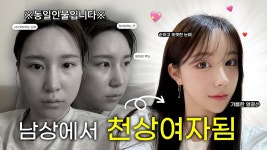 남상이었던얼굴 청순녀로살려드림|윤곽3종+코재수술(기증늑)+눈(뒤밑트임) - kakaoTV 남상이었던얼굴 청순녀로살려드림|윤곽3종+코재수술... 