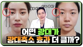 광대축소술로 효과보는 케이스는? l 옆광대, 45도 광대 l 광대축소 효과없는 경우ㅣ디에이 - kakaoTV 광대축소술로 효과보는 케이스는? l... 