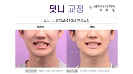 [해운대교정치과 좌동 뉴욕스마일치과] 덧니교정(덧니/비발치교정/2급부정교합) B&A :: 해운대덧니교정 - kakaoTV ﻿[해운대교정치과 좌동... 