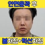 안면윤곽후처짐 방법은 있으니까 [안면윤곽턱선처짐,안면윤곽볼처짐] - kakaoTV 안면윤곽후처짐 방법은 있으니까 [안면윤곽턱선처짐... 