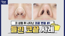 코 성형 후 생긴 코끝 변형..?!｜#들린코 #들창코｜원인부터 해결 방법까지! - kakaoTV 코 성형 후 생긴 코끝 변형..?!｜#들린코 #들창코... 