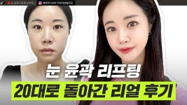 30대 성형 브이로그 ㅣ 리프팅, 안면윤곽, 눈성형 ㅣ 디에이성형외과 ㅣ 디에이성형외과의원 - kakaoTV 30대 성형 브이로그 ㅣ 리프팅, 안면윤곽... 