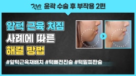 윤곽수술 부작용! 해결할 수 있는 3가지 방법! - kakaoTV 윤곽수술 부작용! 해결할 수 있는 3가지 방법!