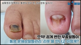 통영 문제성발톱 관리는 리풋으로! - kakaoTV 으악?! 무좀을 치료해줄 사람 어디 없나? 통영 문제성발톱 관리는 리풋으로!