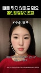 얼굴 가득한 볼살을 V라인으로 만들어준 리프팅 - kakaoTV 얼굴 가득한 볼살을 V라인으로 만들어준 리프팅 