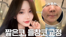 짧은코,들창코, 구축코 재수술 | 포기하지 말고 코 잘하는 병원... 짧은코,들창코, 구축코 재수술  | 포기하지 말고 코 잘하는 병원 알아보세용