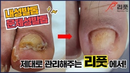 통영발톱무좀 통영발관리 통영여행 통영맛집 리풋 살통영 - kakaoTV 통영내성발톱 통영발톱무좀 통영발관리 통영여행 통영맛집 리풋 살통영