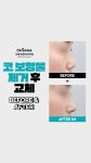 💗코보형물제거 후 교체💗 강남역 오썸성형외과 코성형 BEFORE&AFTER - kakaoTV 💗코보형물제거 후 교체💗 강남역 오썸성형외과... 