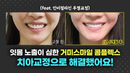 보철이네유부댕댕 | 보철이 있어도 교정 OK✨ " - kakaoTV 잇몸이 많이 보이는 거미스마일 고민, 치아교정으로 해결했어요! 보철이 있어도 교정 OK✨ "