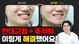 반대교합+주걱턱 전형적인 제3급부정교합 교정 했더니 이렇게 변신했어요! - kakaoTV 반대교합+주걱턱 전형적인 제3급부정교합 교정 했더니... 
