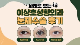 | 수원 이상호성형외과 - kakaoTV 유형별 눈재수술 사례로 살펴보는 쌍꺼풀 재수술 성공 후기!  | 수원 이상호성형외과